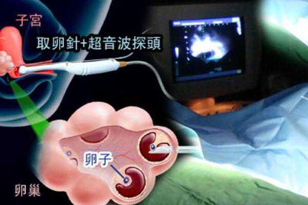 广州想找女子代孕|齐齐哈尔有可以申请供卵做三代试管婴儿的医院吗？