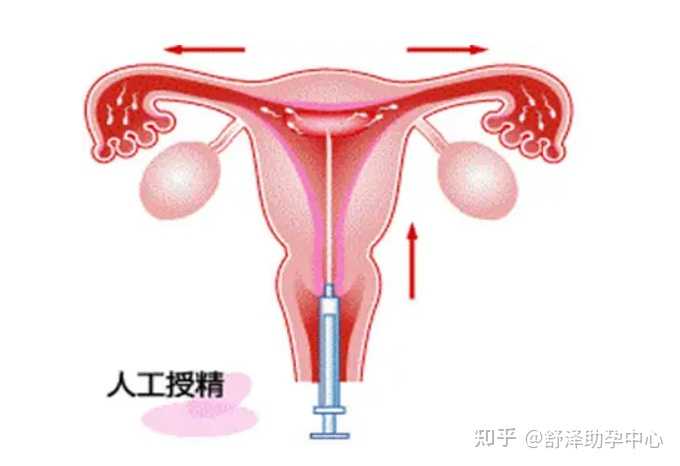 广东三代试管婴儿：广州供卵试管机构怎么联系，可以医保报销吗？_代孕机构